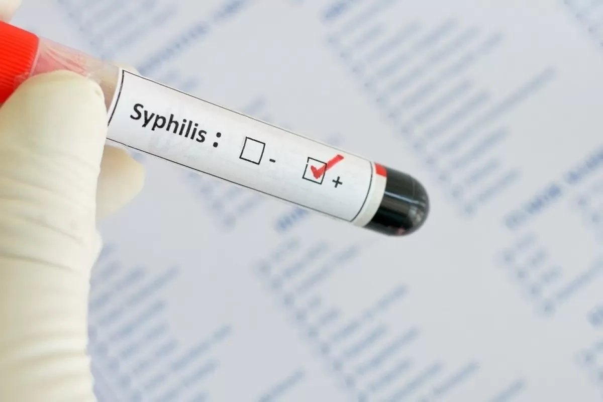 Crece 40% la sífilis en jóvenes y Córdoba lidera el avance