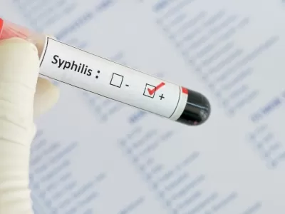Crece 40% la sífilis en jóvenes y Córdoba lidera el avance